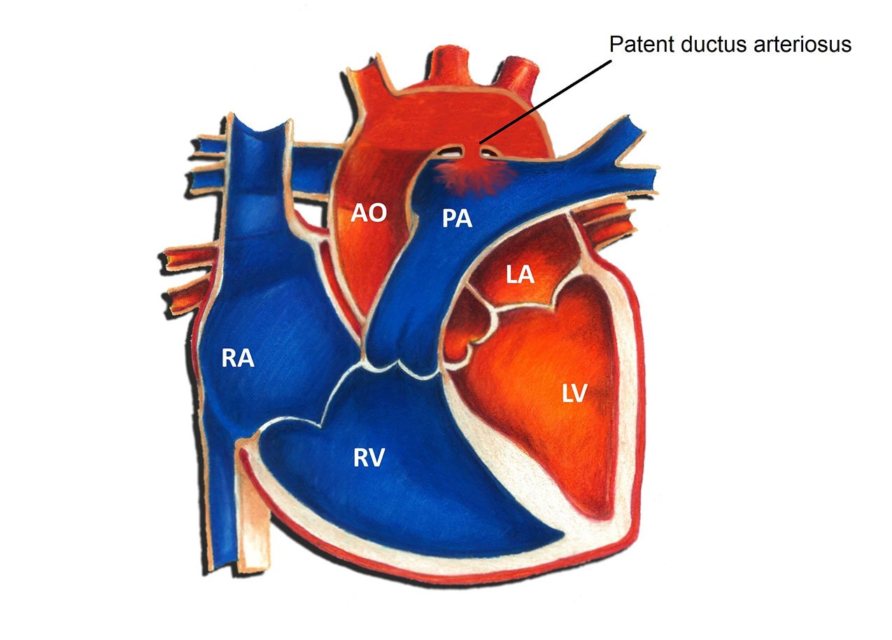 triangle-of-ductus-arteriosus